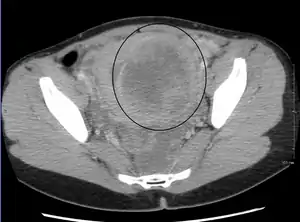 A very large (9&nbsp;cm) fibroid of the uterus which is causing pelvic congestion syndrome as seen on CT