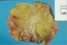 Excised human breast tissue, showing an irregular, dense, white stellate area of cancer 2&nbsp;cm in diameter, within yellow fatty tissue