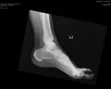 Ectopic calcification and new bone formation in diffuse idiopathic skeletal hyperostosis (DISH)