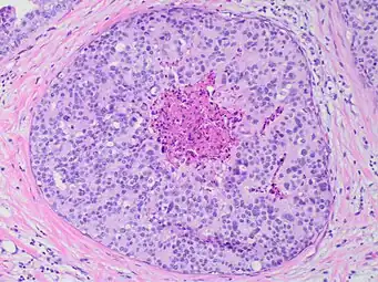 Ductal carcinoma in situ with comedo necrosis spanning 30% of its diameter, which is generally regarded as the minimal size to classify it as comedo.