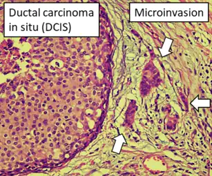 DCIS with microinvasion, defined as focus of invasive cancer measuring up to 1.0&nbsp;mm in size.
