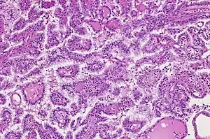 Gross appearance of Papillary renal cell carcinoma