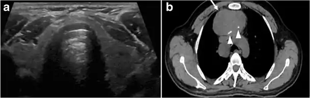 Fig. 4. A 45-year-old male patient presented with anterior mediastinal metastatic PTC lesions and occult primary on imaging. Histopathology examination of the resected thyroid gland revealed micro-foci of PTC; the largest, in the isthmus, measured 4&nbsp;mm. a transverse greyscale ultrasound of the thyroid demonstrates homogeneous gland with normal echogenicity and size. No focal lesion or micro-calcifications. b Non-enhanced CT scan obtained as part of PET/CT examination shows a heterogeneous, large, relatively dense anterior mediastinal mass (white arrow) with peripheral calcification (arrowheads). Thyroid gland has normal CT appearance with no abnormal FDG uptake (not shown).