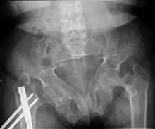Brown tumors in the pelvis and a hip fracture.